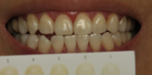ホワイトニング後の白い歯