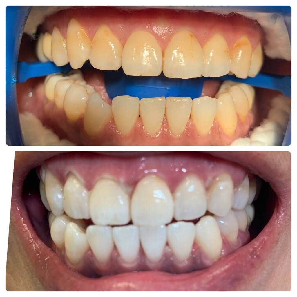 ホワイトニング前後の歯