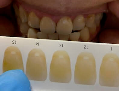 デンタルホワイトニングの前の歯
